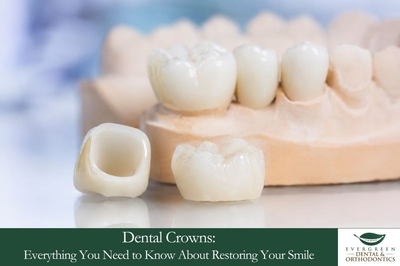 Dental Crowns Everything You Need to Know About Restoring Your Smile