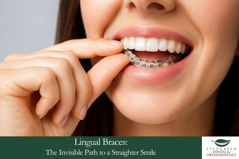 Lingual Braces The Invisible Path to a Straighter Smile